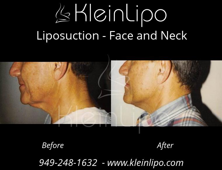 Liposuction-FaceandNeck-2-28-2018-11-48-05