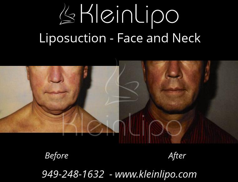 Liposuction for Men San Francisco