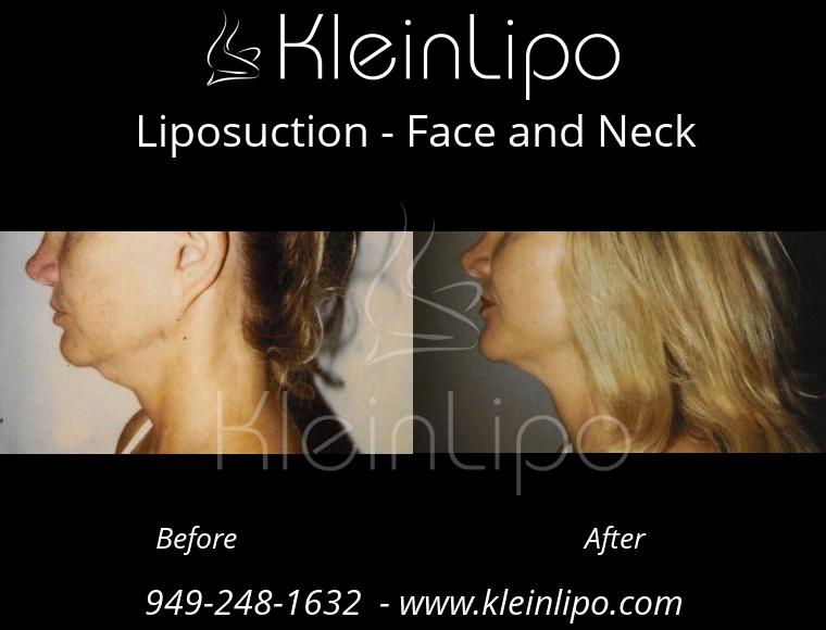 Liposuction-FaceandNeck-2-28-2018-11-48-11