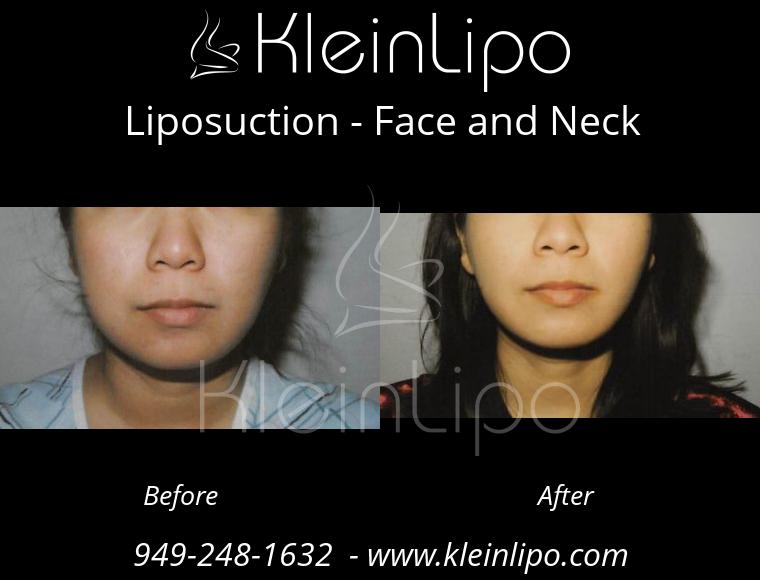 Liposuction-FaceandNeck-2-28-2018-11-48-13