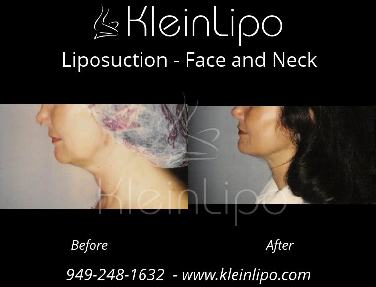 Arm Liposuction - KleinLipo - Liposuction Surgery of Orange County