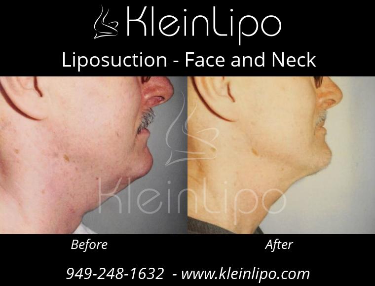 Liposuction-FaceandNeck-2-28-2018-11-48-18