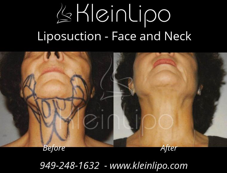 Liposuction - Dr. G Cosmetic Surgery