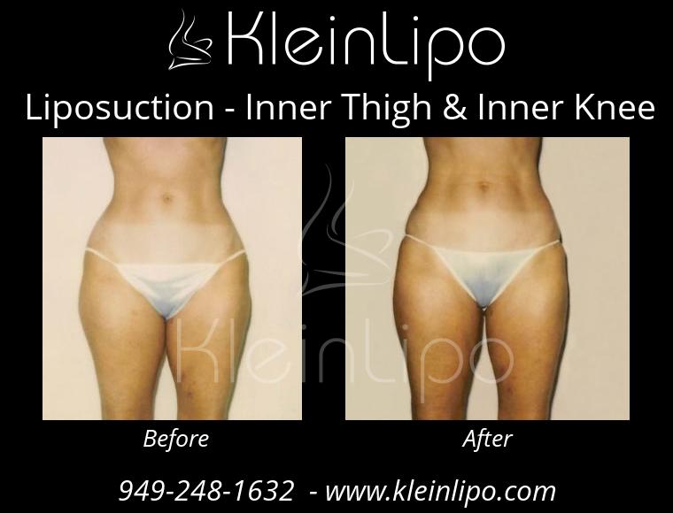 Liposuction InnerThigh&InnerKnee 2 27 2018 16 41 50