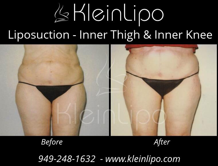 Liposuction-InnerThigh&InnerKnee-2-27-2018-16-41-52