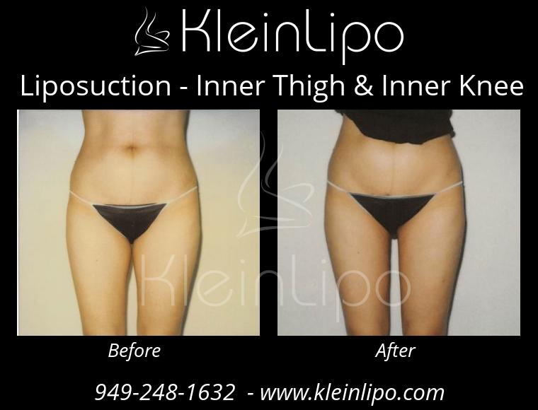 Liposuction-InnerThigh&InnerKnee-2-27-2018-16-41-56