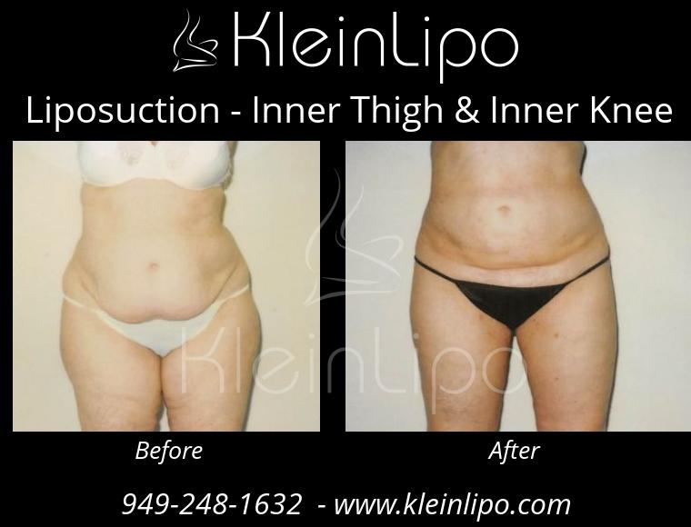 Liposuction InnerThigh&InnerKnee 2 27 2018 16 41 58