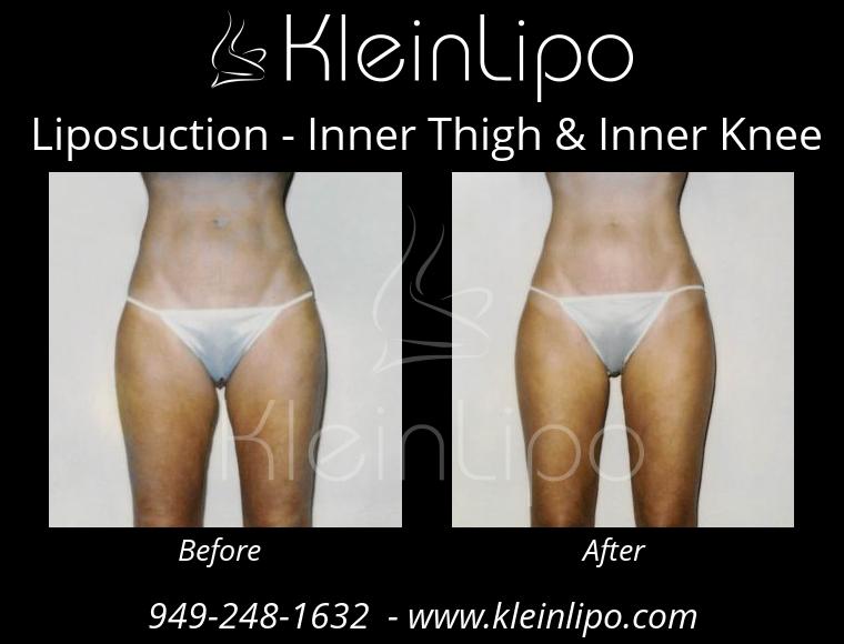 Liposuction InnerThigh&InnerKnee 2 27 2018 16 42 01