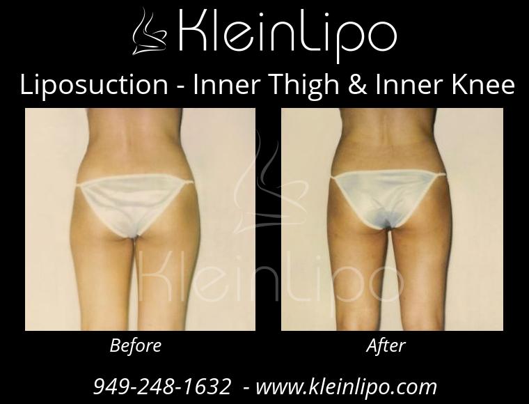 Liposuction InnerThigh&InnerKnee 2 27 2018 16 42 05