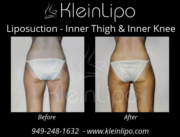 Liposuction-InnerThigh&InnerKnee-2-27-2018-16-42-06