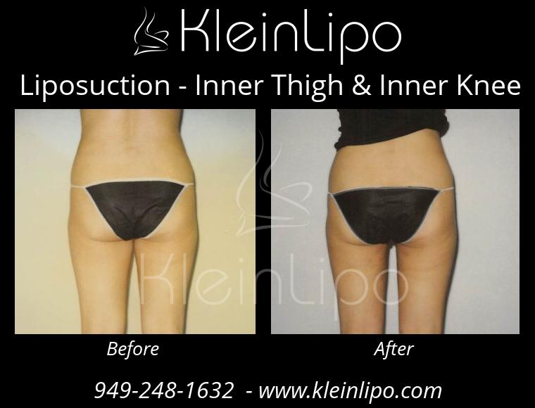 Liposuction InnerThigh&InnerKnee 2 27 2018 16 42 18