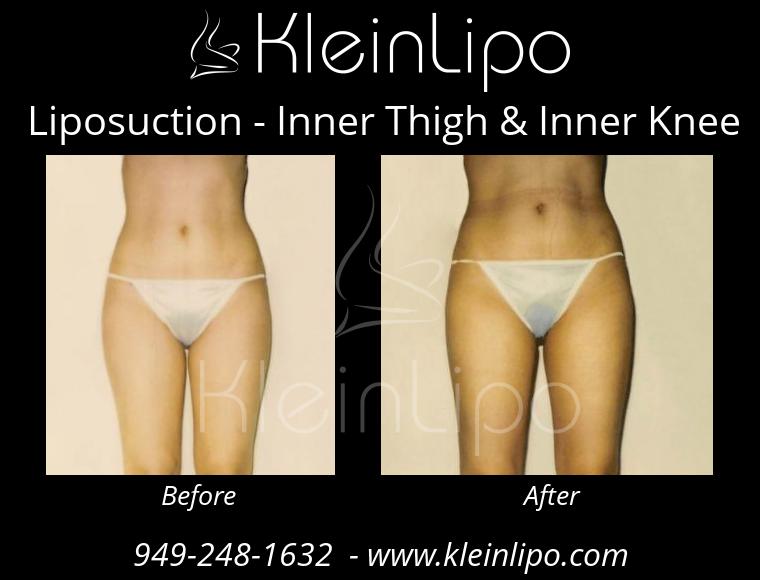 Liposuction InnerThigh&InnerKnee 2 27 2018 16 42 23