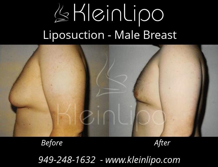 Liposuction-MaleBreast-2-27-2018-18-41-24