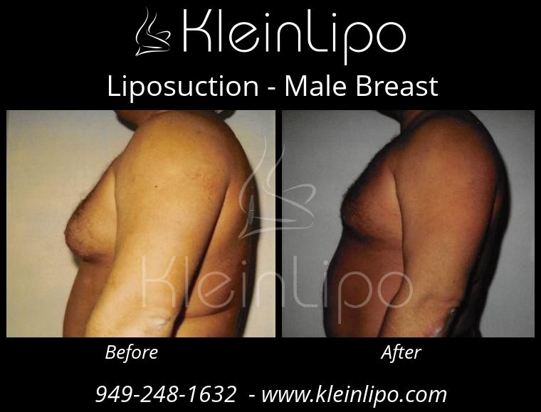 Liposuction MaleBreast 2 27 2018 18 41 26
