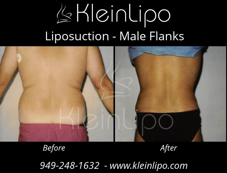 Liposuction of the Love Handles or Flanks  Reduce Sides, Love Handles and  Flanks with Liposuction 