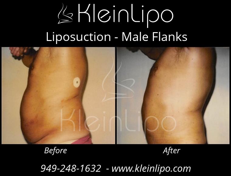 Male Flanks Liposuction - KleinLipo - Liposuction Surgery of Orange County