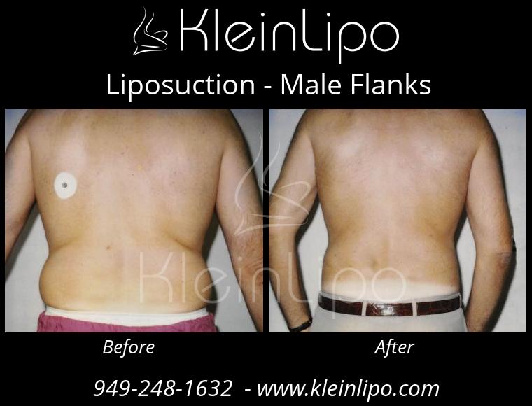 Male Waist, Sides and Flanks