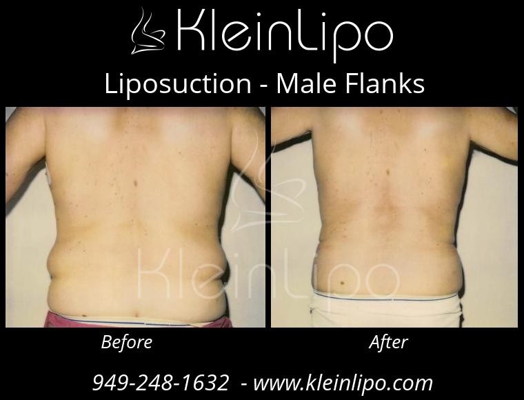 Male Flanks Liposuction - KleinLipo - Liposuction Surgery of Orange County