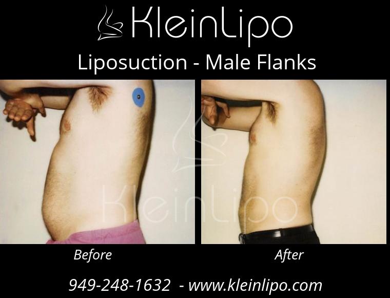 Liposuction-MaleFlanks-2-27-2018-19-17-14