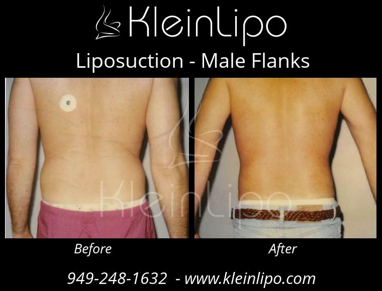 Liposuction of the Love Handles or Flanks  Reduce Sides, Love Handles and  Flanks with Liposuction 