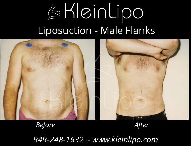 Male Flanks Liposuction - KleinLipo - Liposuction Surgery of Orange County