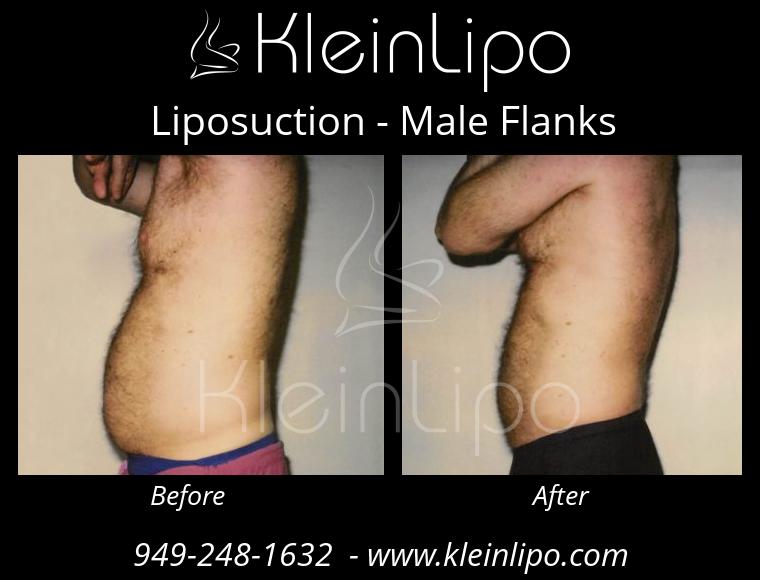 Male Waist, Sides and Flanks