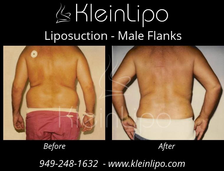 Liposuction-MaleFlanks-2-27-2018-19-17-23