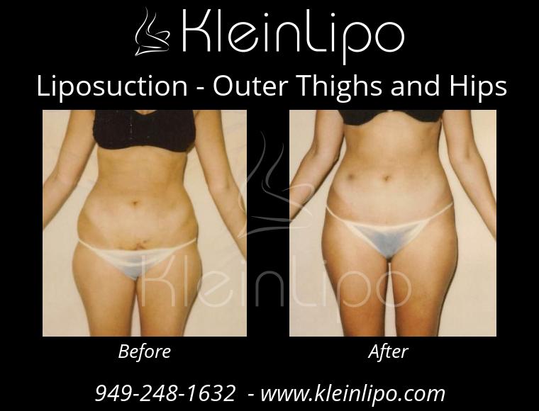 Liposuction OuterThighsandHips 2 27 2018 16 44 36