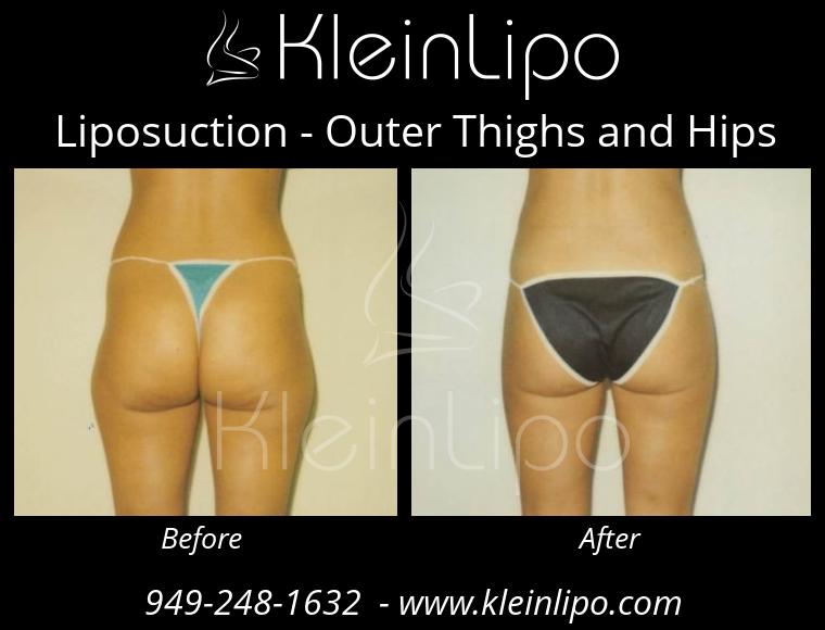Liposuction-OuterThighsandHips-2-27-2018-16-44-39