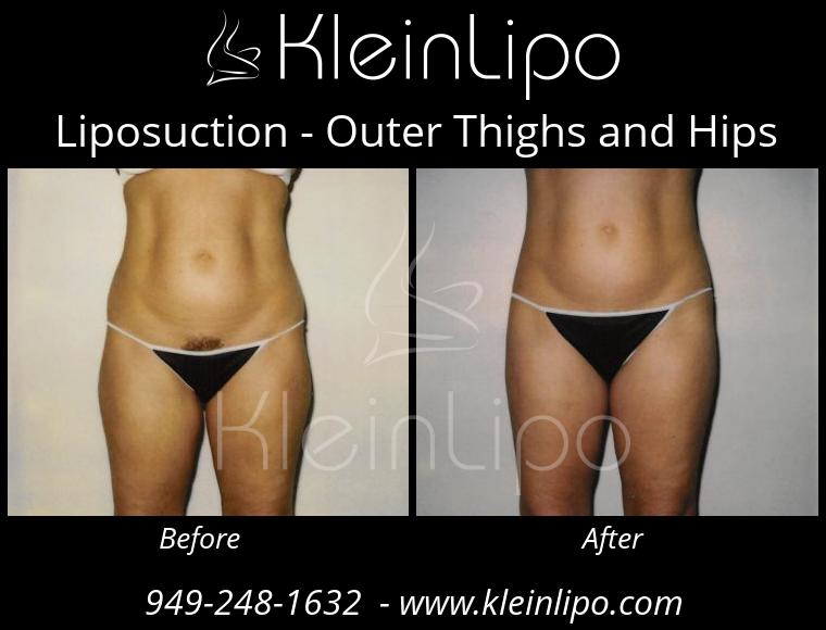 Liposuction-OuterThighsandHips-2-27-2018-16-44-42
