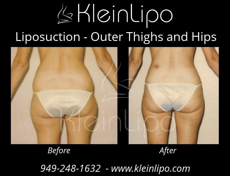 Liposuction OuterThighsandHips 2 27 2018 16 44 44