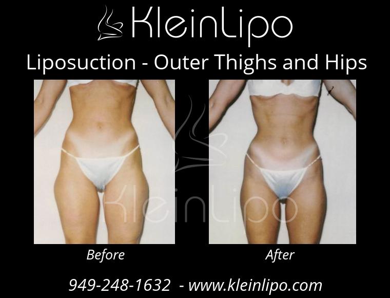 Liposuction-OuterThighsandHips-2-27-2018-16-44-45