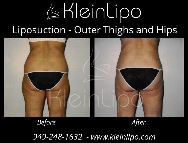 Liposuction-OuterThighsandHips-2-27-2018-16-44-46