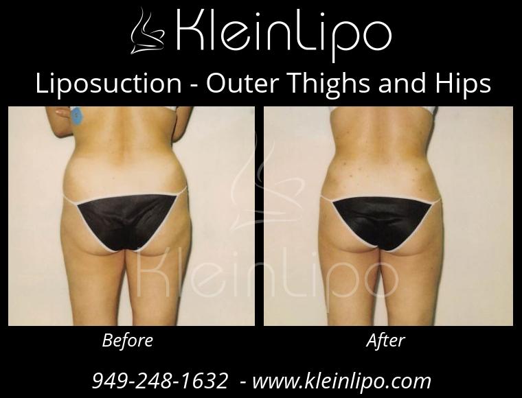 Liposuction OuterThighsandHips 2 27 2018 16 45 30