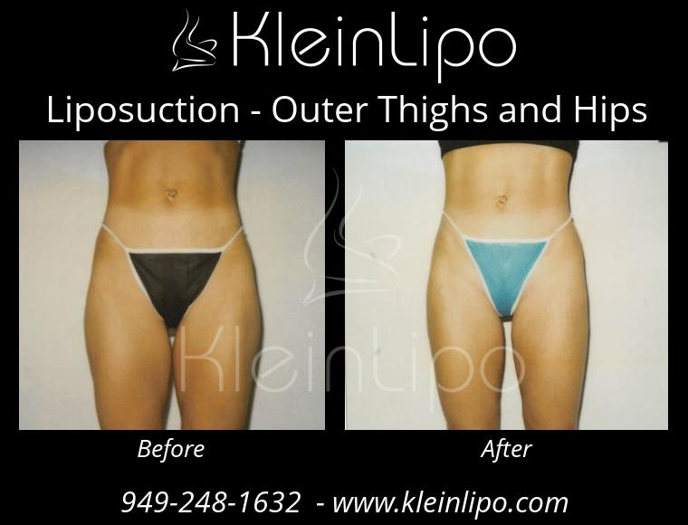 Liposuction-OuterThighsandHips-2-27-2018-16-45-32