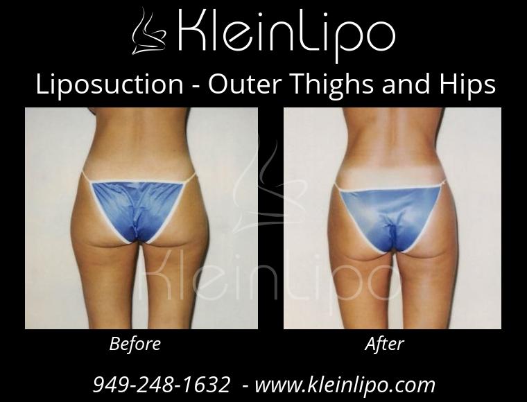 Liposuction OuterThighsandHips 2 27 2018 16 45 35