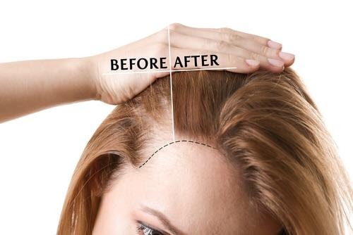 PRF for Thinning Hair