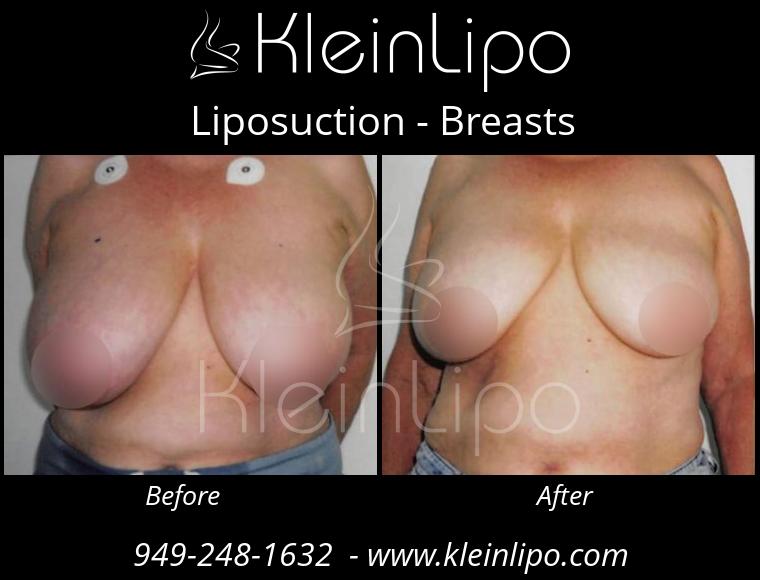 Liposuction-Breasts-10-26-2018-11-53-14