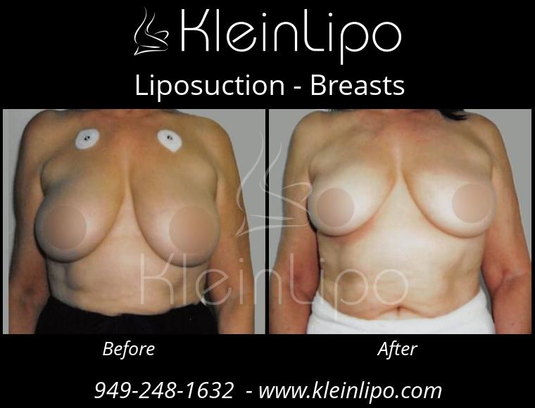 Liposuction-Breasts-10-26-2018-12-04-01