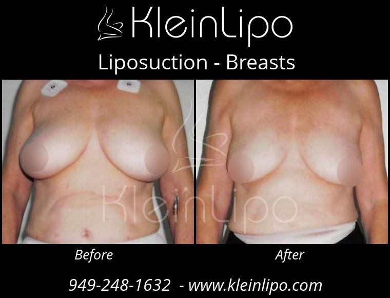 Liposuction-Breasts-10-26-2018-12-04-07