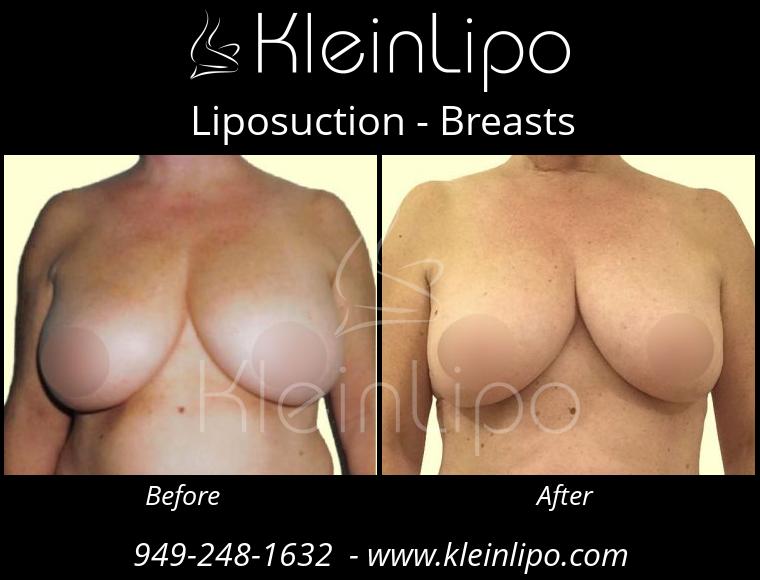 Liposuction Breasts 10 26 2018 12 04 35