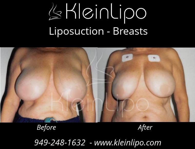 Liposuction-Breasts-10-26-2018-15-57-18