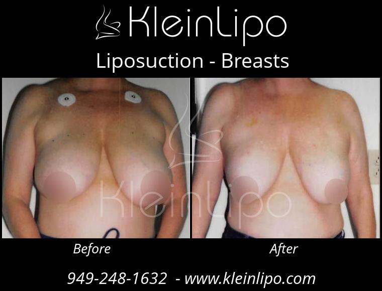 Liposuction Breasts 10 29 2018 11 46 44