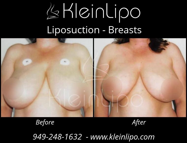 Liposuction-Breasts-10-29-2018-11-49-17