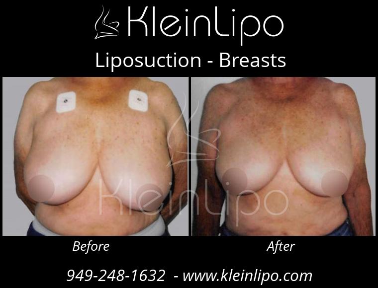 Liposuction-Breasts-10-29-2018-11-51-15