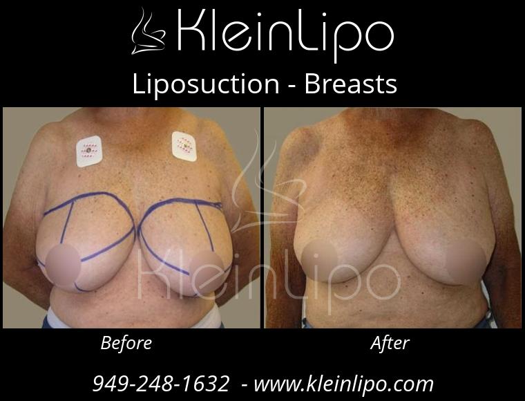 Liposuction-Breasts-10-29-2018-11-53-54