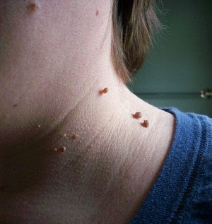 skin-tags