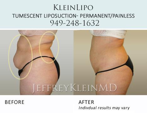 lipo